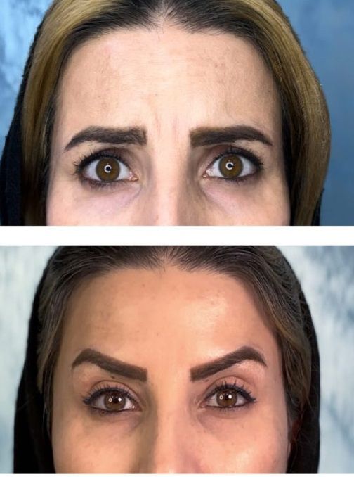 تزریق بوتاکس پیشانی شرق تهران
بهترین بوتاکس پیشانی شرق تهران
بوتاکس هروی